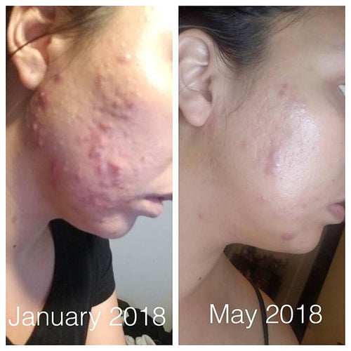 Super Acne Fighter / Organic Acne Treatment / Acne Pung.G