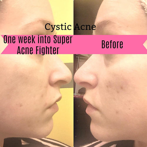 Super Acne Fighter / Organic Acne Treatment / Acne Pung.G